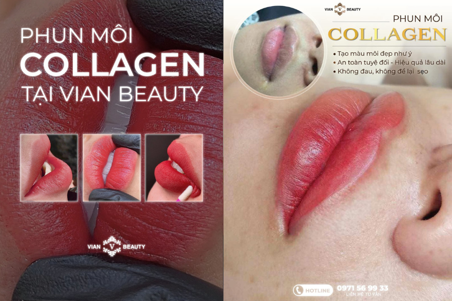 Phun Moi Collagen Len Mau Chuan Tai Vian Beauty Hcm
