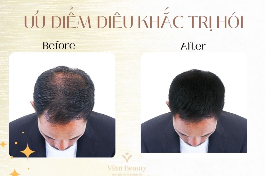 Uu Diem Dieu Khac Toc