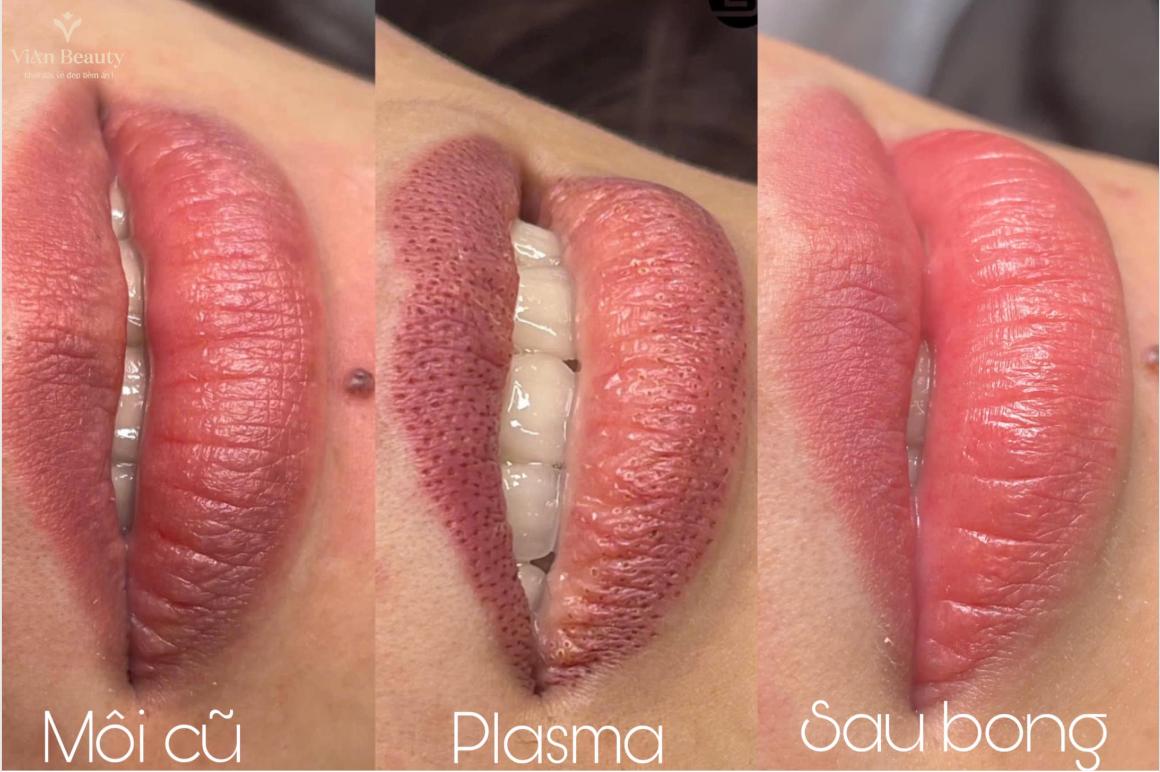 Xoa Sua Moi Cu Tra Lai Nen Moi Tu Nhien Vian Beuaty 5