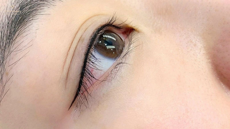 Ai Nên Phun Mí Mở Tròng?