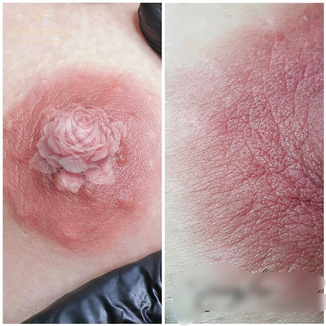 Phun Hồng Nhũ Hoa Chuẩn Kỹ Thuật Tại Vian Beauty