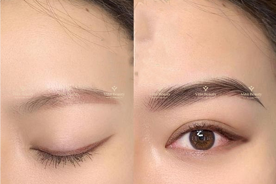 Thời Gian Lý Tưởng Để Dặm Lại Mí Là Sau Phun 1-2 Năm